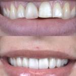 Veneers before and after photo