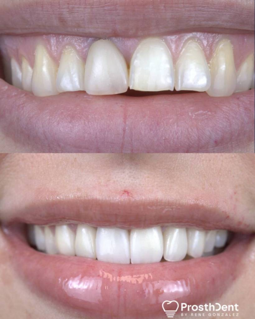 Veneers before and after photo