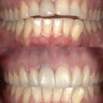 Veneers before and after photo