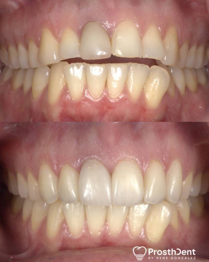 Veneers before and after photo